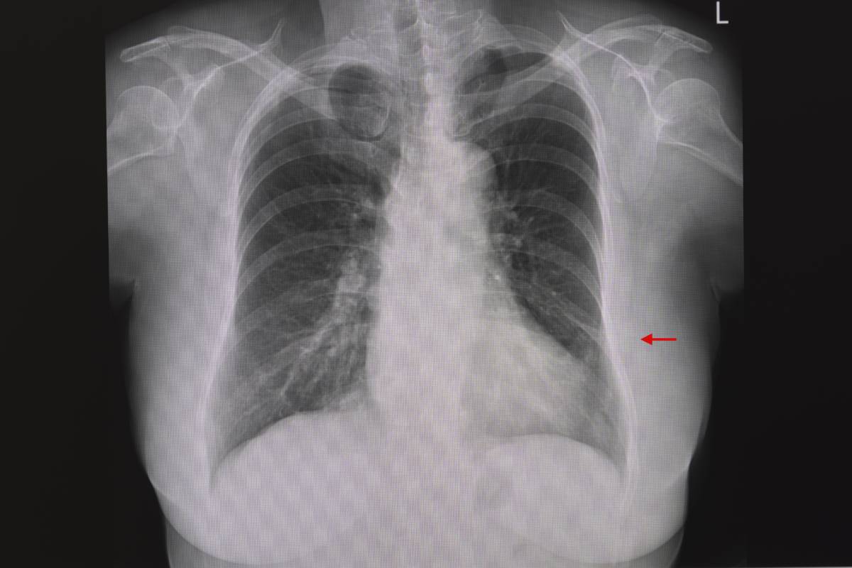 Prevention of Atelectasis After General Anesthesia