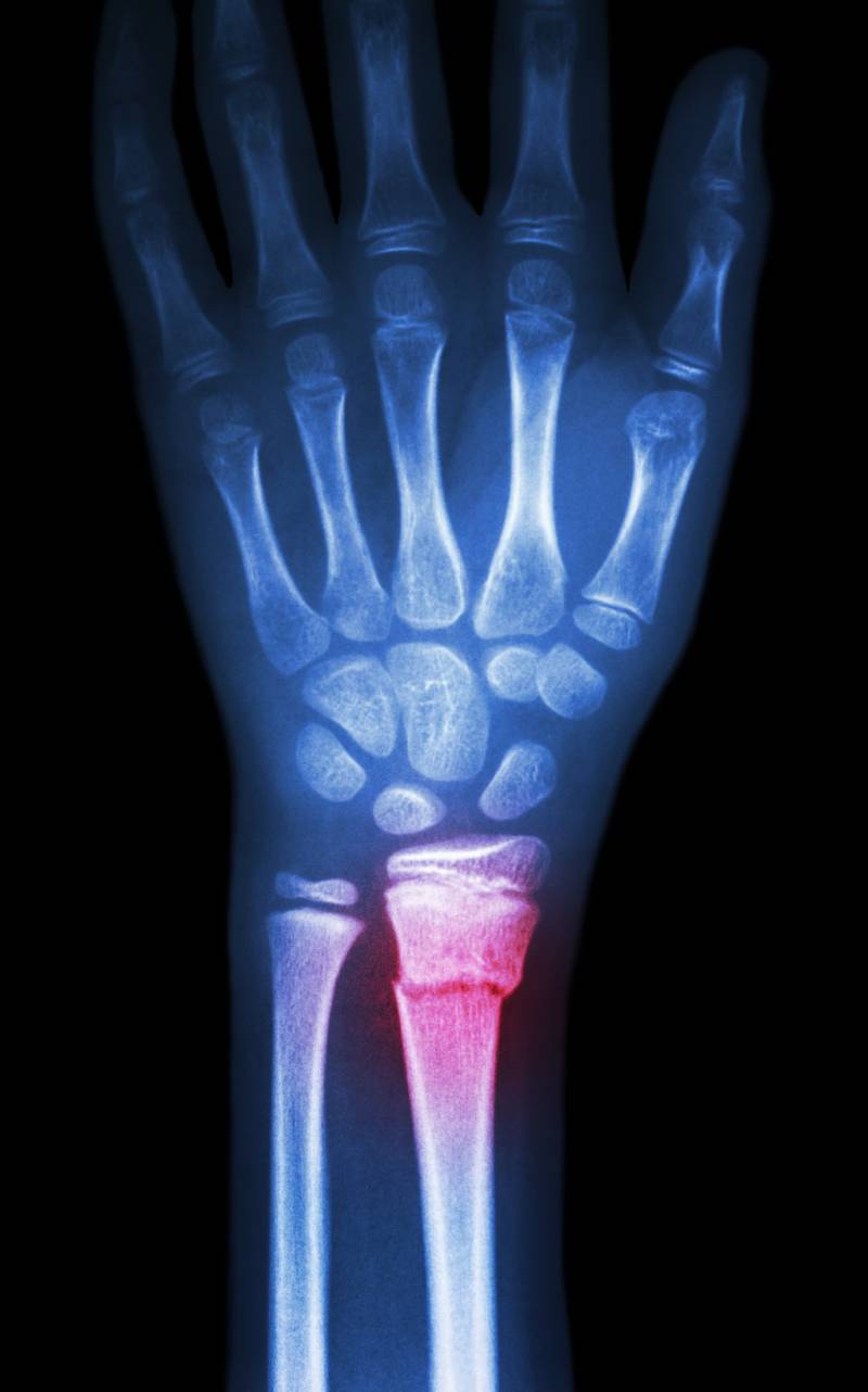 Distal Radius Repair: Comparison of Anesthetic Options