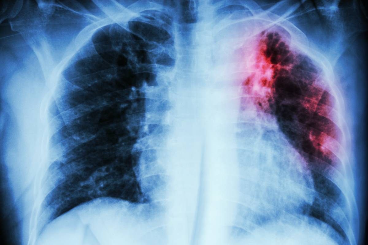 Tuberculosis: A Public Health Overview